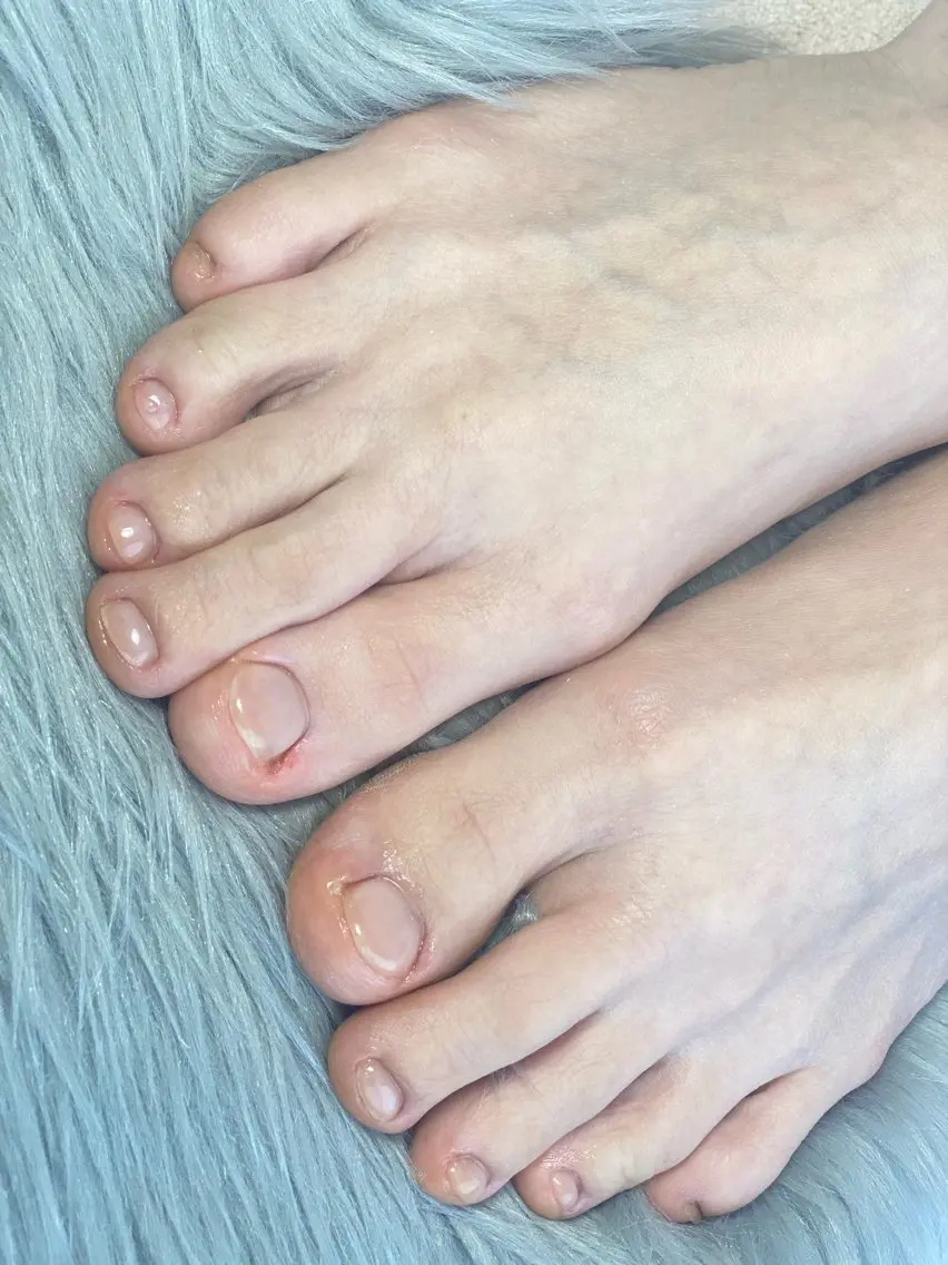 フットネイルお悩み改善コースの写真