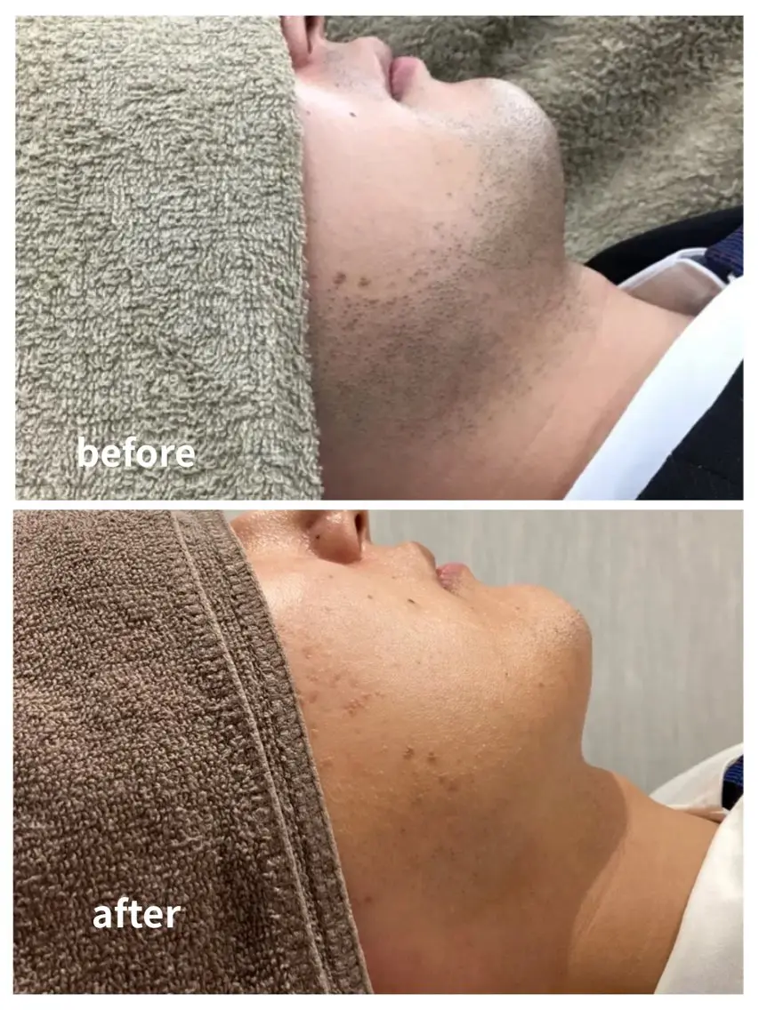 【青ヒゲ改善】初回メンズ顔脱毛¥3000の写真