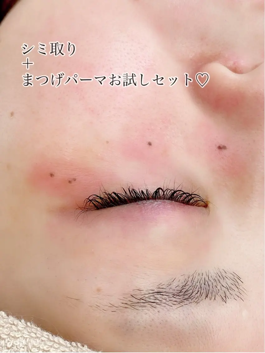 当日予約限定♡まつげパーマ(ラッシュリフト)+シミ取り10個お試しセット¥12000の写真
