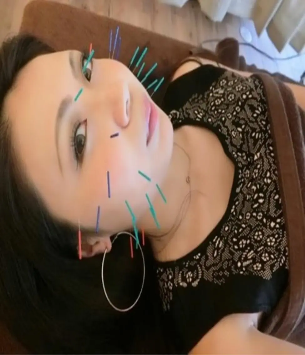 フルボディ美容鍼（美容鍼＋美容整体＋体への鍼灸施術＋肩甲骨はがし＋くびれ施術）　90分の写真