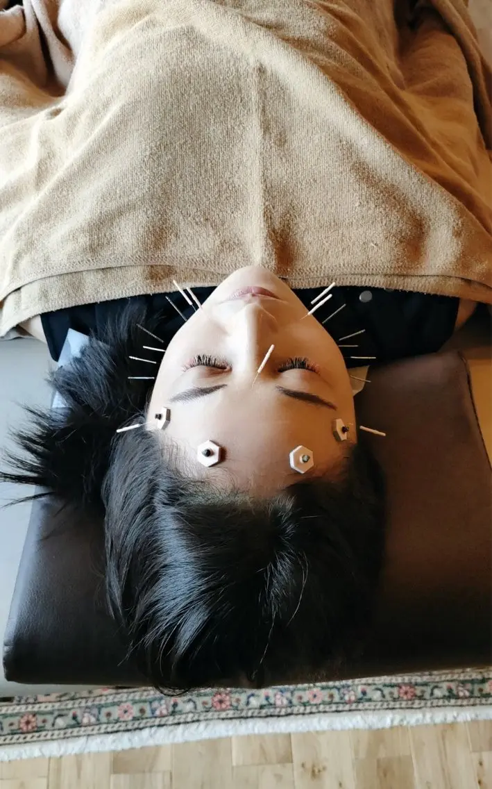 リベルシフォンピーリング＋美容鍼の写真