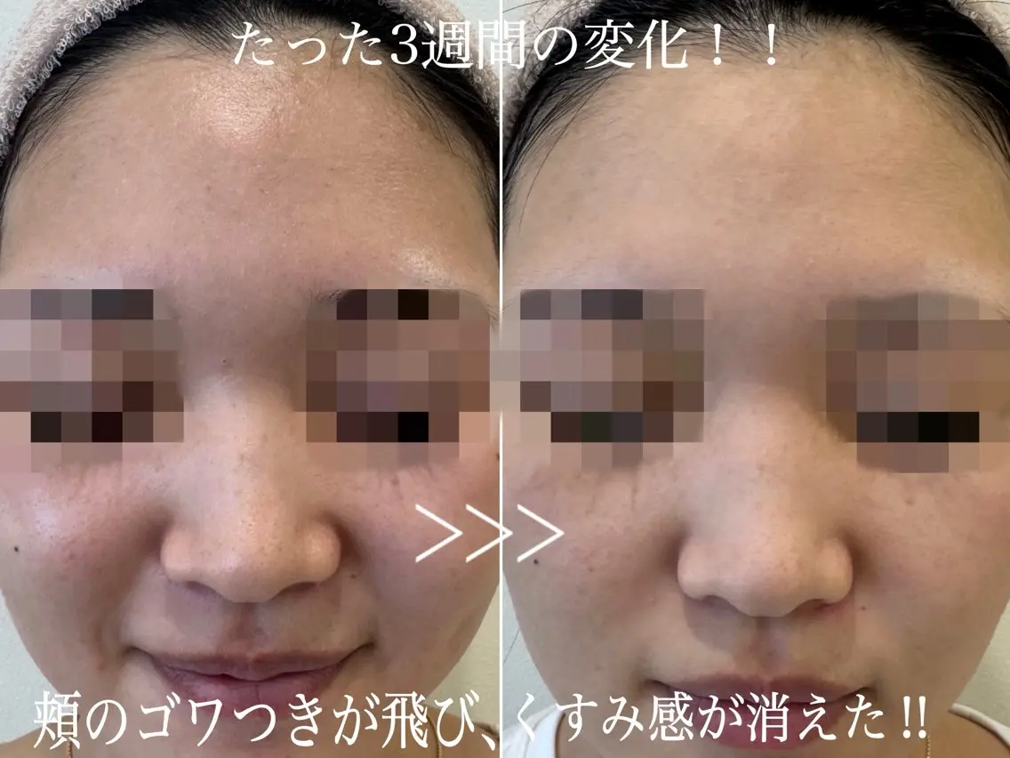 毛穴開き黒ずみ ニキビ特化💆♀️のエステ・リラクイメージ