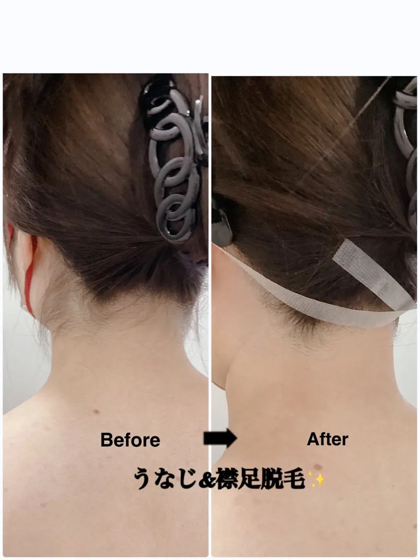 👱‍♀️うなじ&襟足脱毛👱‍♀️ ミニモ学割❗️30分平日学生限定🈹¥2,800→¥1,500の写真