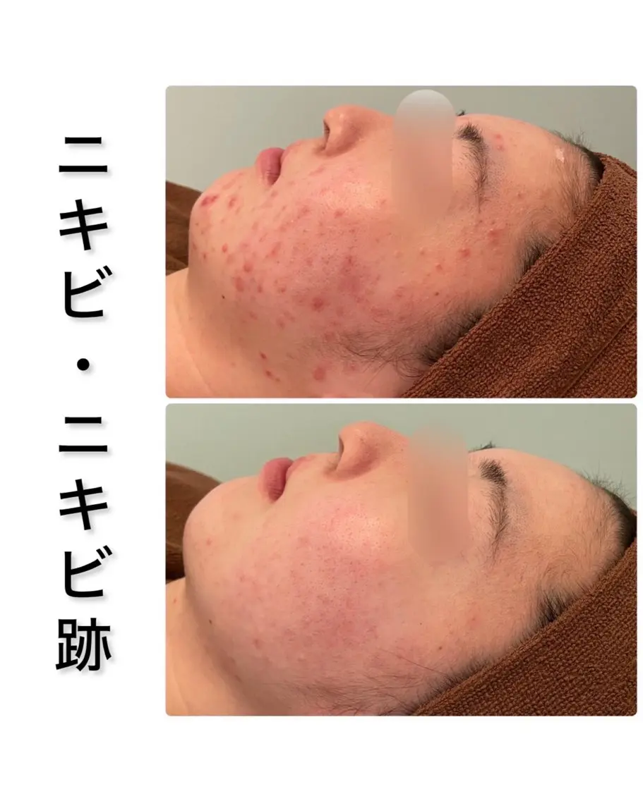 その他 ハーブピーリング専門 BIOPLUS+川崎のエステ・リラクイメージ