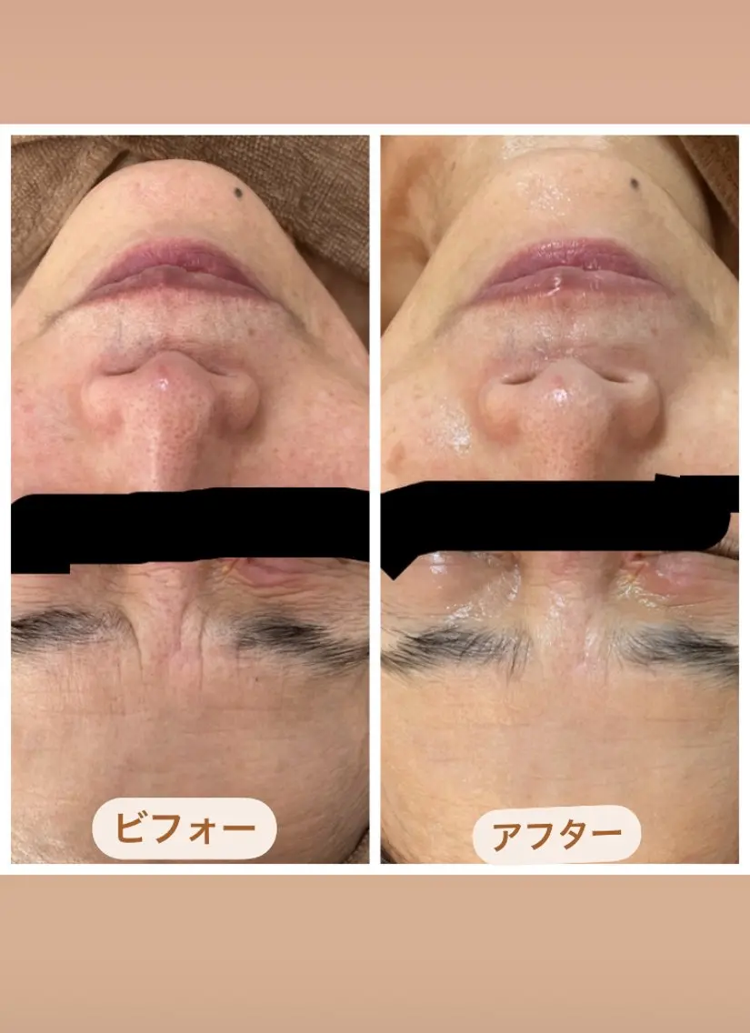 人気のメニュー　　　　　　　　　　　　　　　　　　▪️ヒト幹細胞フェイシャルエステ(スペシャル)の写真