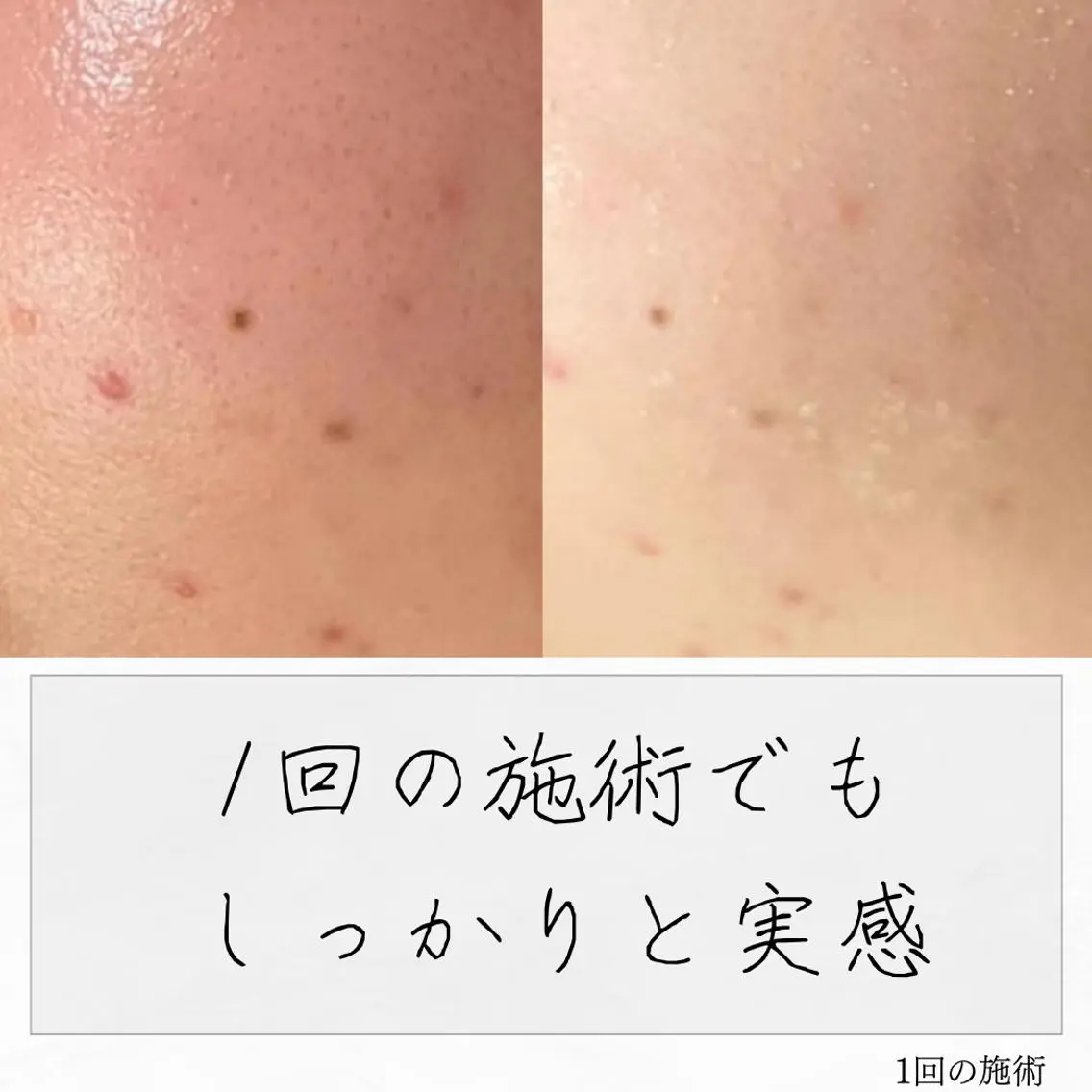 ニキビ経験者が施術 する専門サロン🌻のエステ・リラクイメージ