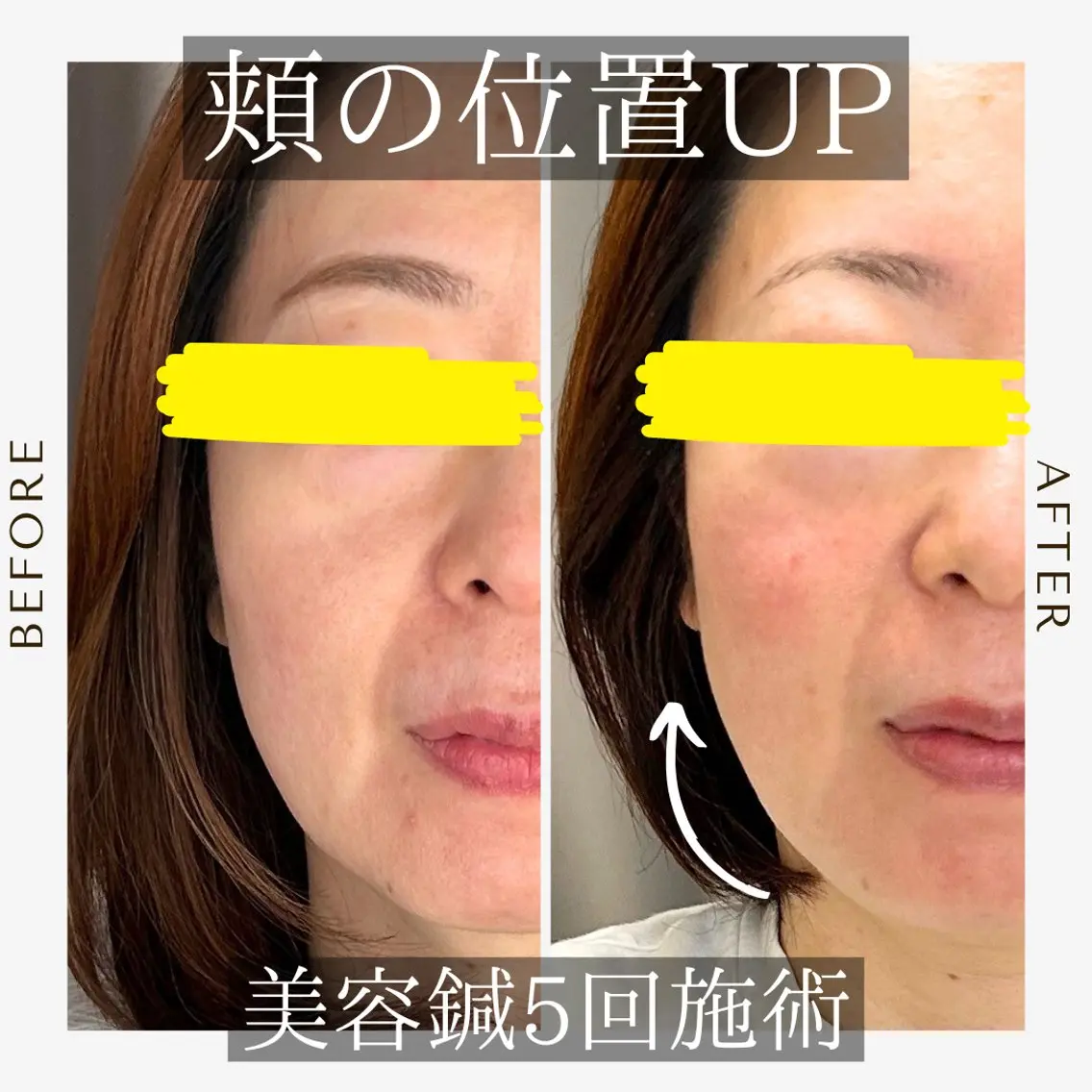 《美肌･小顔》美容鍼 ＆マッサージ＊MEIのエステ・リラクイメージ