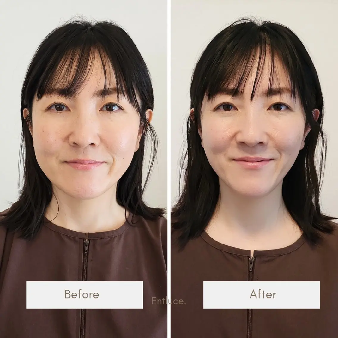 【モニター募集📷オトクな3回プラン】美容鍼即小顔✨リフトアップ💆60分|電流⚡で引き上げMAXの写真