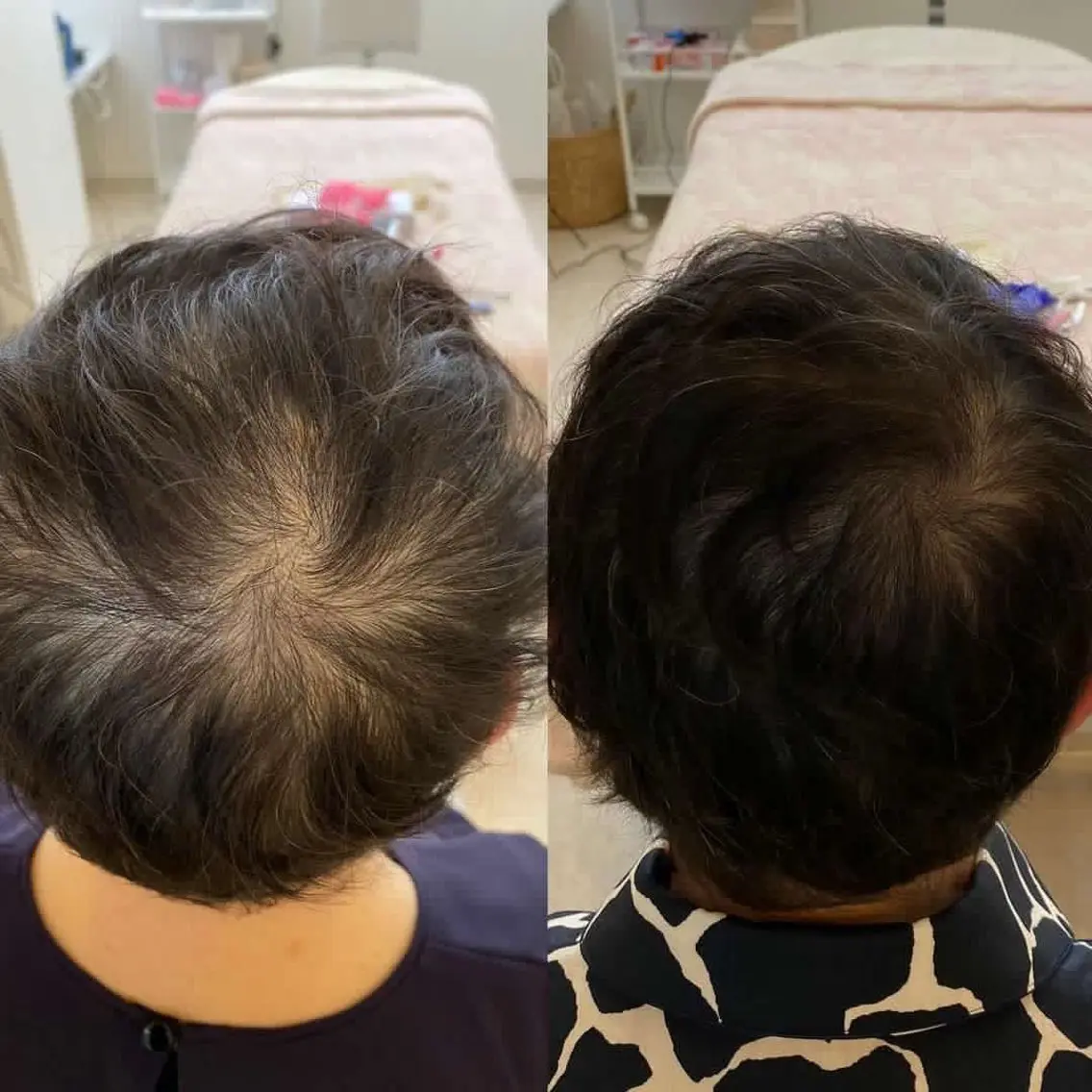 プロセルセラピーズ・薄毛・抜け毛・細毛の写真