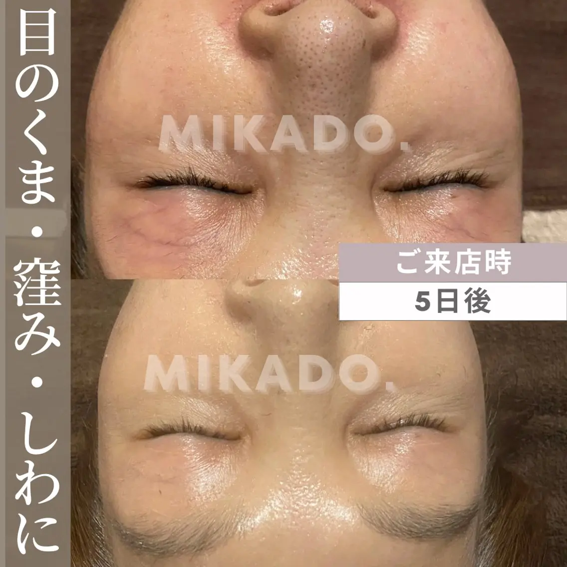 【目のくま、くすみ、しわ、睫育】ハーブピーリンググリーンピールアイサークル【30分】¥7700の写真