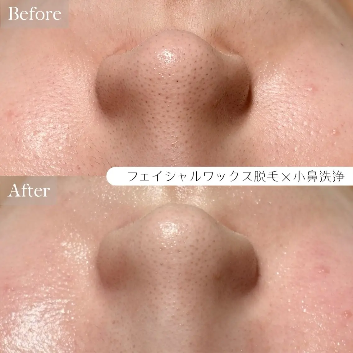 脱毛 ルコル池袋【毛穴洗浄 /wax顔脱毛】えみのエステ・リラクイメージ