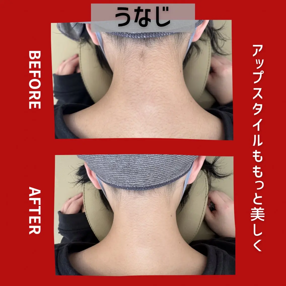 【女性人気】うなじ脱毛の写真