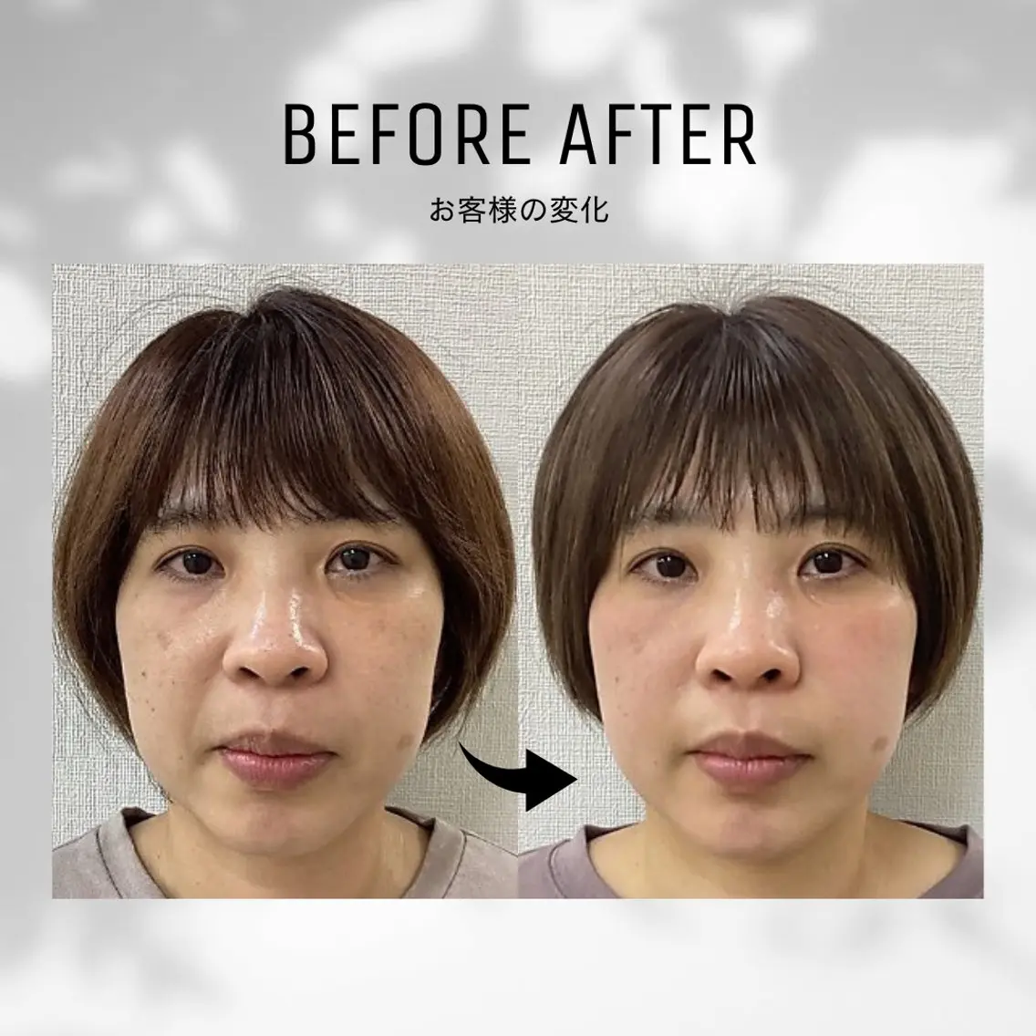 【顔のむくみ・重たい印象に♡】小顔ケア×温感ラジオ波の写真
