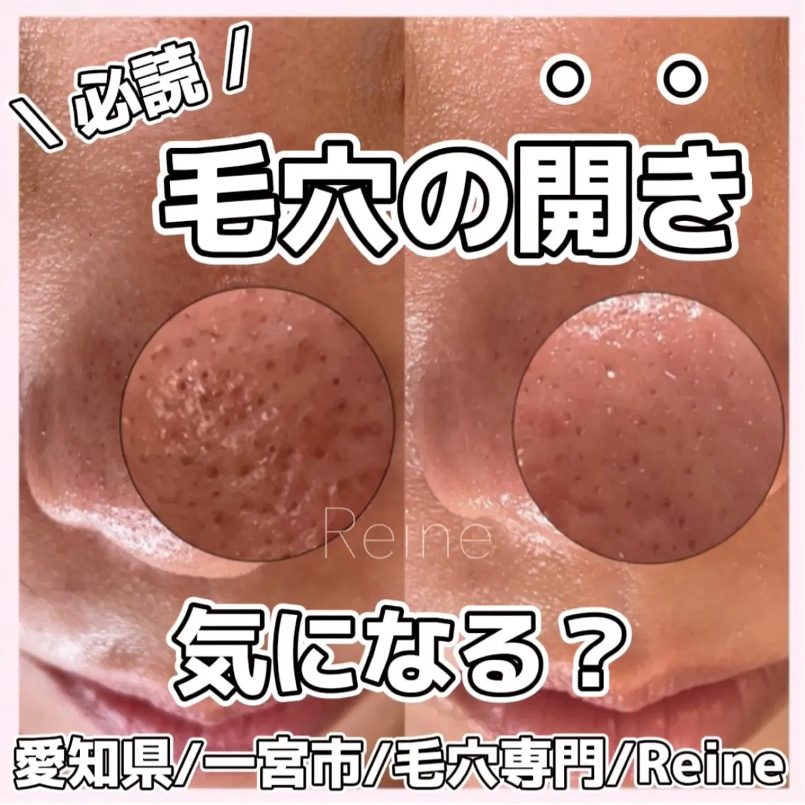 毛穴/シミ肝斑/脱毛 横山梨里のエステ・リラクイメージ