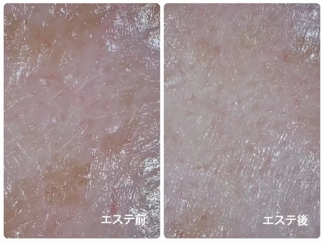リフトアップ/美白/毛穴引き締め効果あり🫧超音波エステの写真