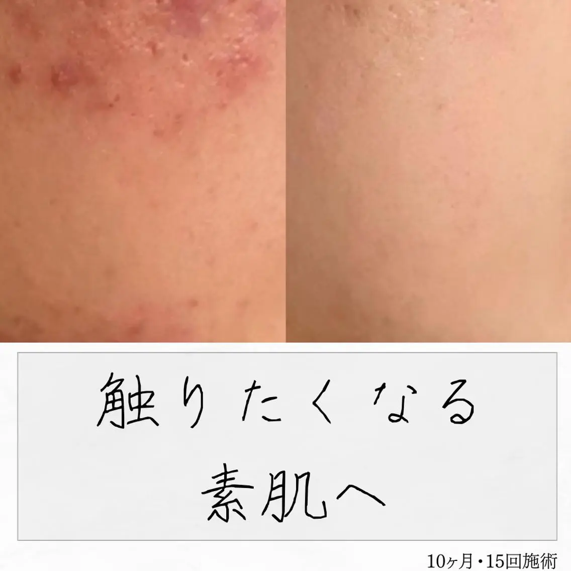 ニキビ経験者が施術 する専門サロン🌻のエステ・リラクイメージ