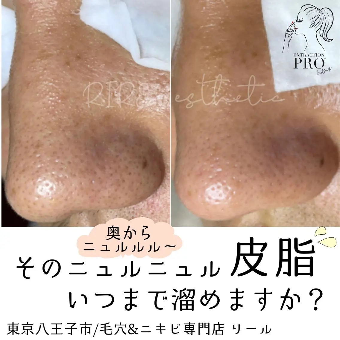 毛穴特化エステ -リールのエステ・リラクイメージ