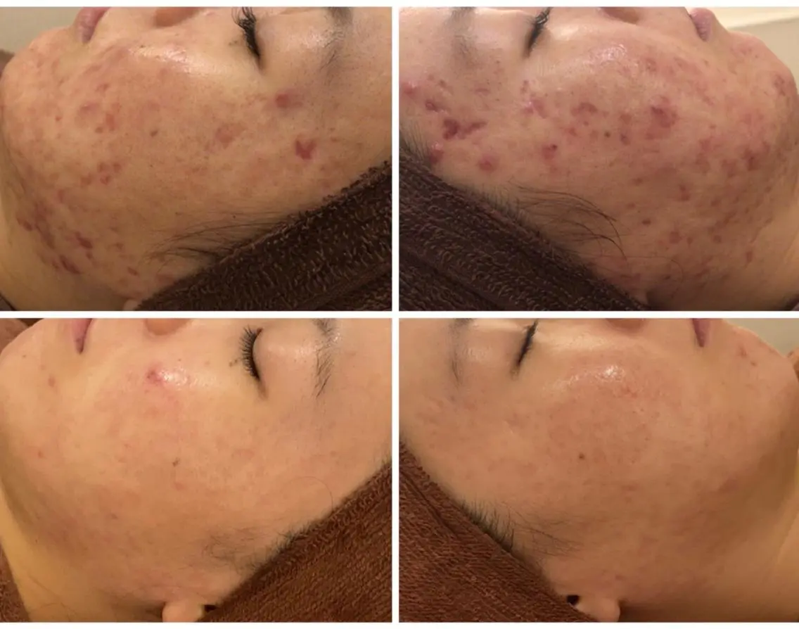ショート カラー パーマ ヘアアレンジ メンズ キッズ ネイル マツエク・マツパ エステ リラク ニキビ・肌質改善専門 ♡人生が変わるサロンのエステ・リラクイメージ