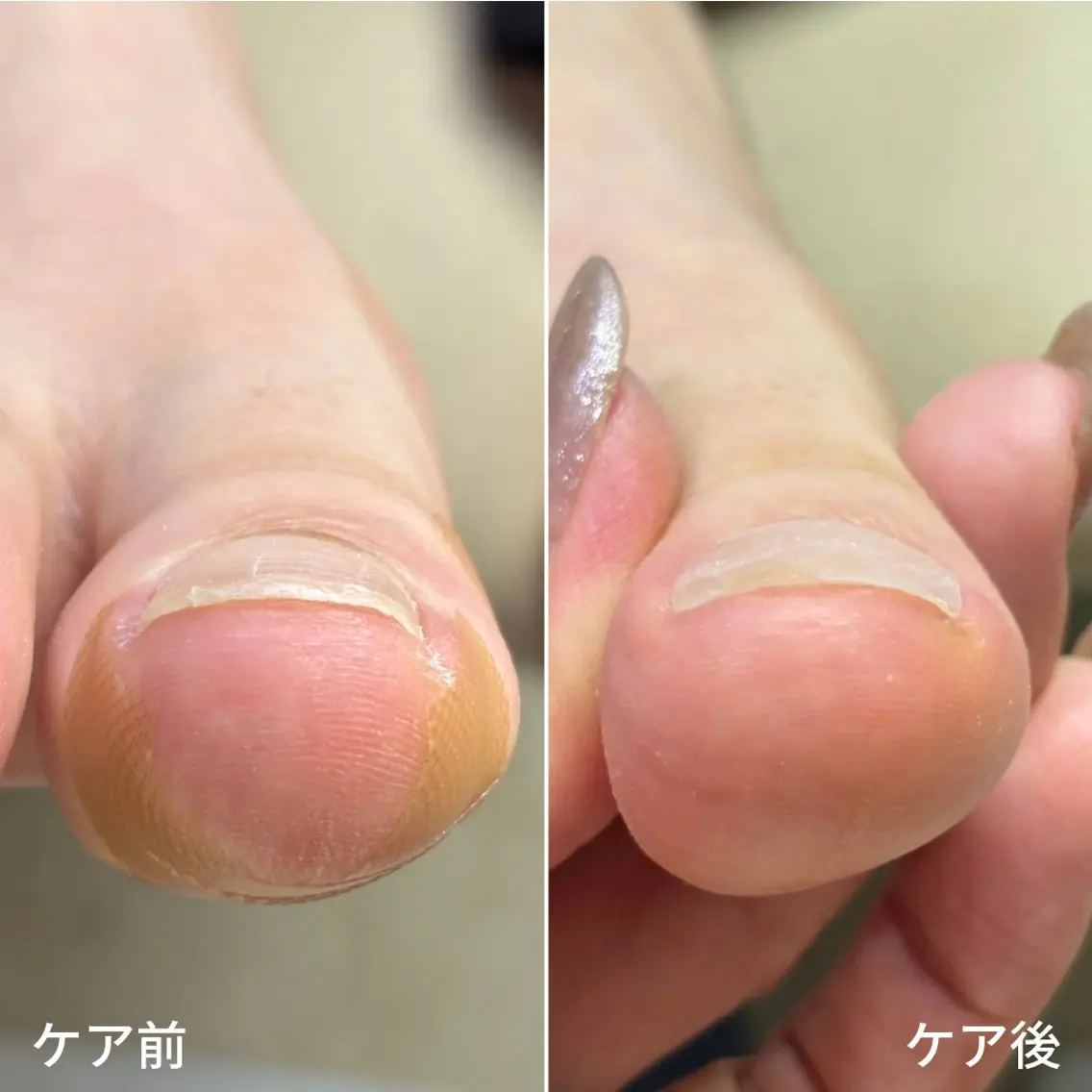 ネイル 巻き爪・肥厚爪ケア 専門サンセリテのネイルデザイン