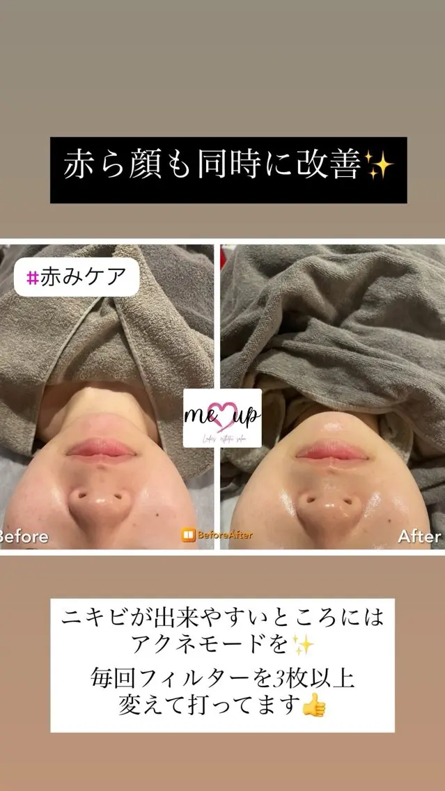 エステ Meupニキビ専門店 背中/ハーブ/肌管理のその他イメージ