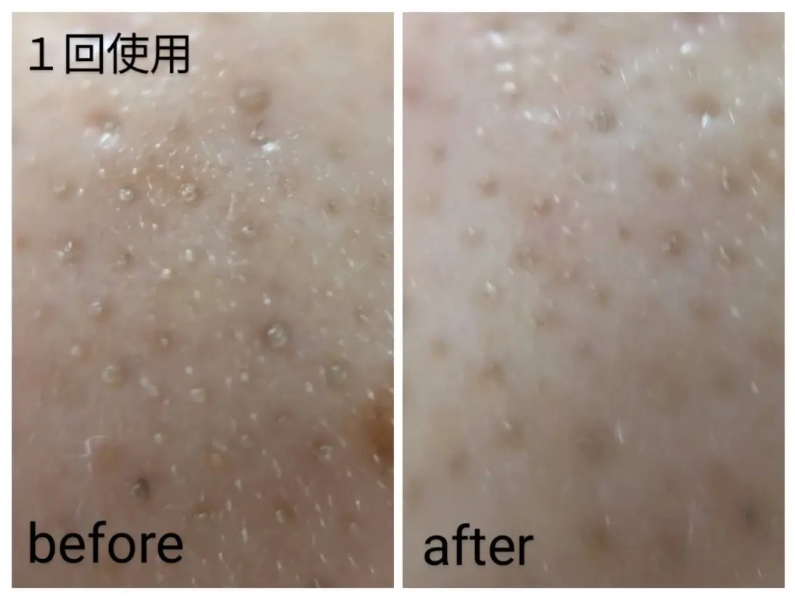 【特別価格】🧡小鼻集中エステ🧡超音波エステ付き　黒ずみ毛穴、ひらき毛穴、毛穴トラブルのないつるすべなお肌にの写真