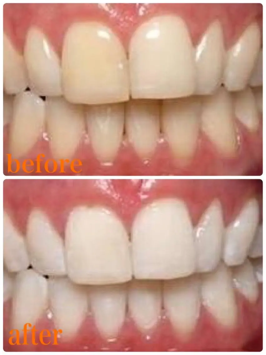 ✨つるつるぴかぴかモテtooth✨♡セルフホワイトニング♡の写真
