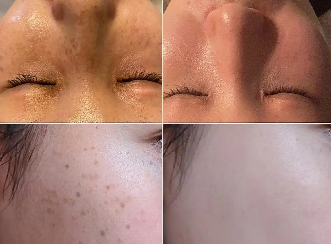 【美容顔脱毛+シミケア】エステ唯一の抜けと美肌&4種フェイシャルで肌修正♪2回目以降は顔脱毛を全回数無料の写真