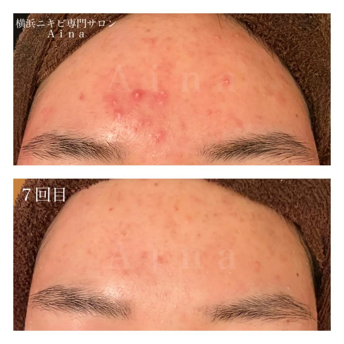 ミディアム カラー パーマ ヘアアレンジ メンズ キッズ ネイル マツエク・マツパ エステ リラク ニキビ跡専門サロン Ainaのエステ・リラクイメージ