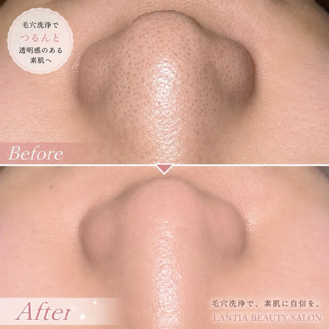 👃鼻だけ毛穴洗浄🫧初回¥3,500🤍の写真