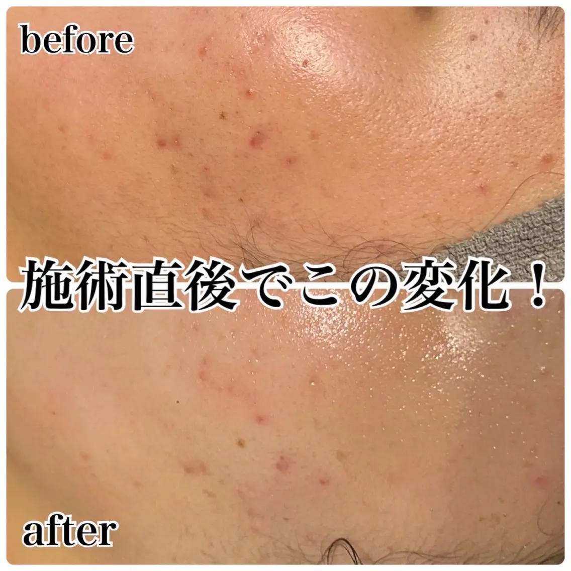 【繰り返すニキビ予防にはコレ！】REVI次世代ハーブ＋高濃度ビタミンC/凸凹改善/300種類の天然ハーブ🌿の写真