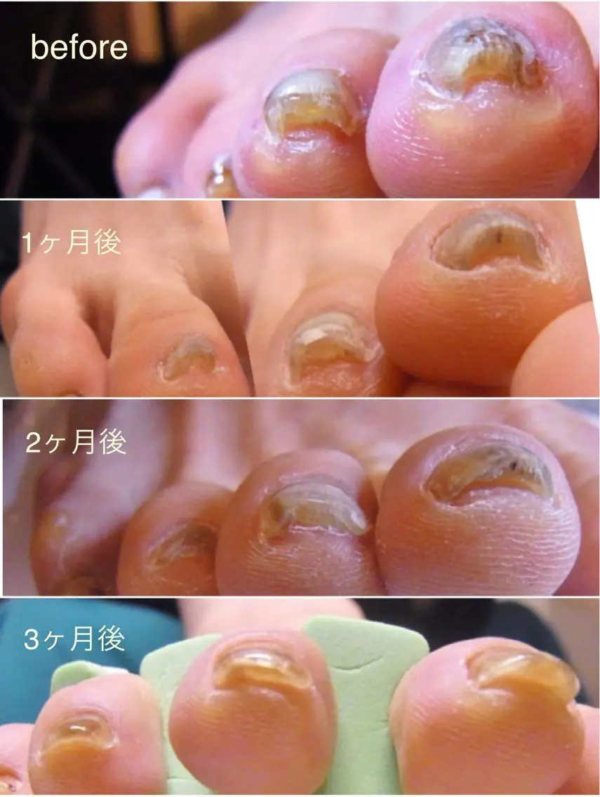 高技術✨巻き爪矯正2本✨対応が難しいとされる親指以外の指も可の写真