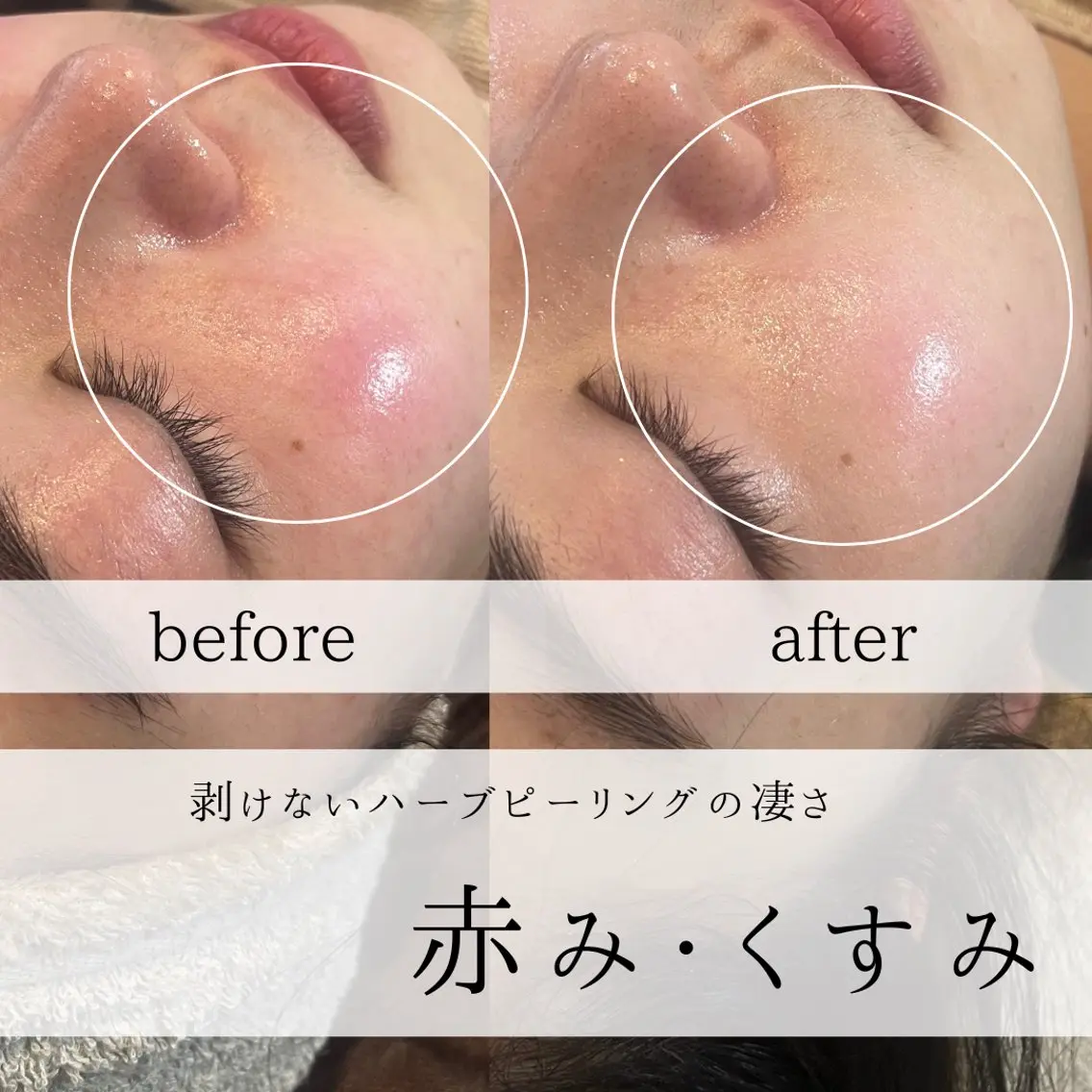 エステ yc.hacci 【ハーブピーリング】の眉毛・アイブロウイメージ