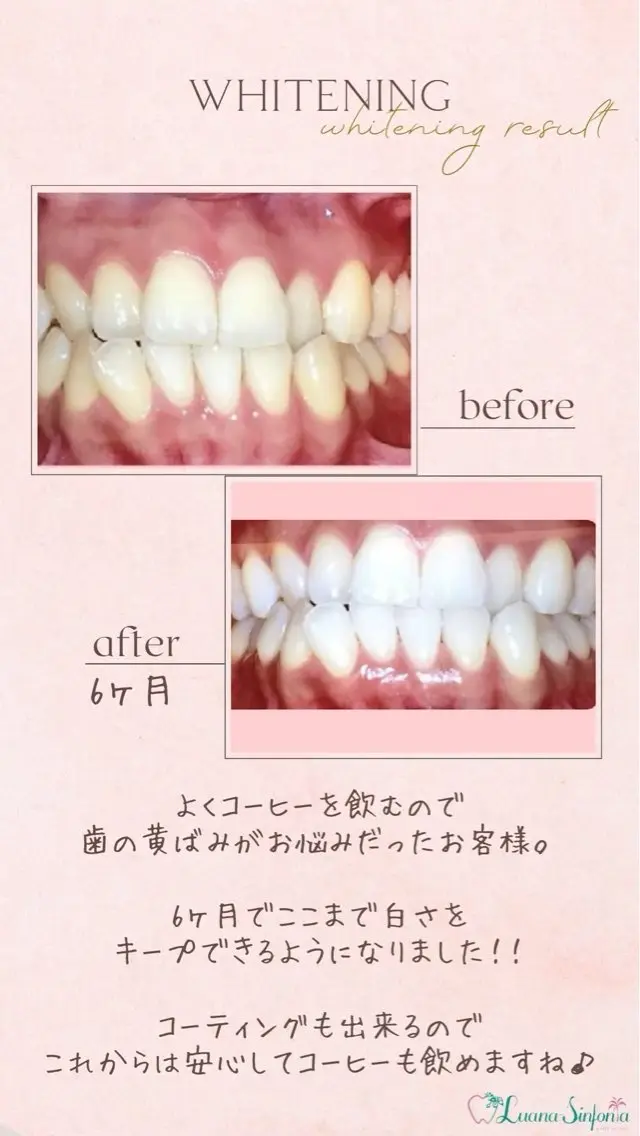 セルフホワイトニング Yuaのその他イメージ