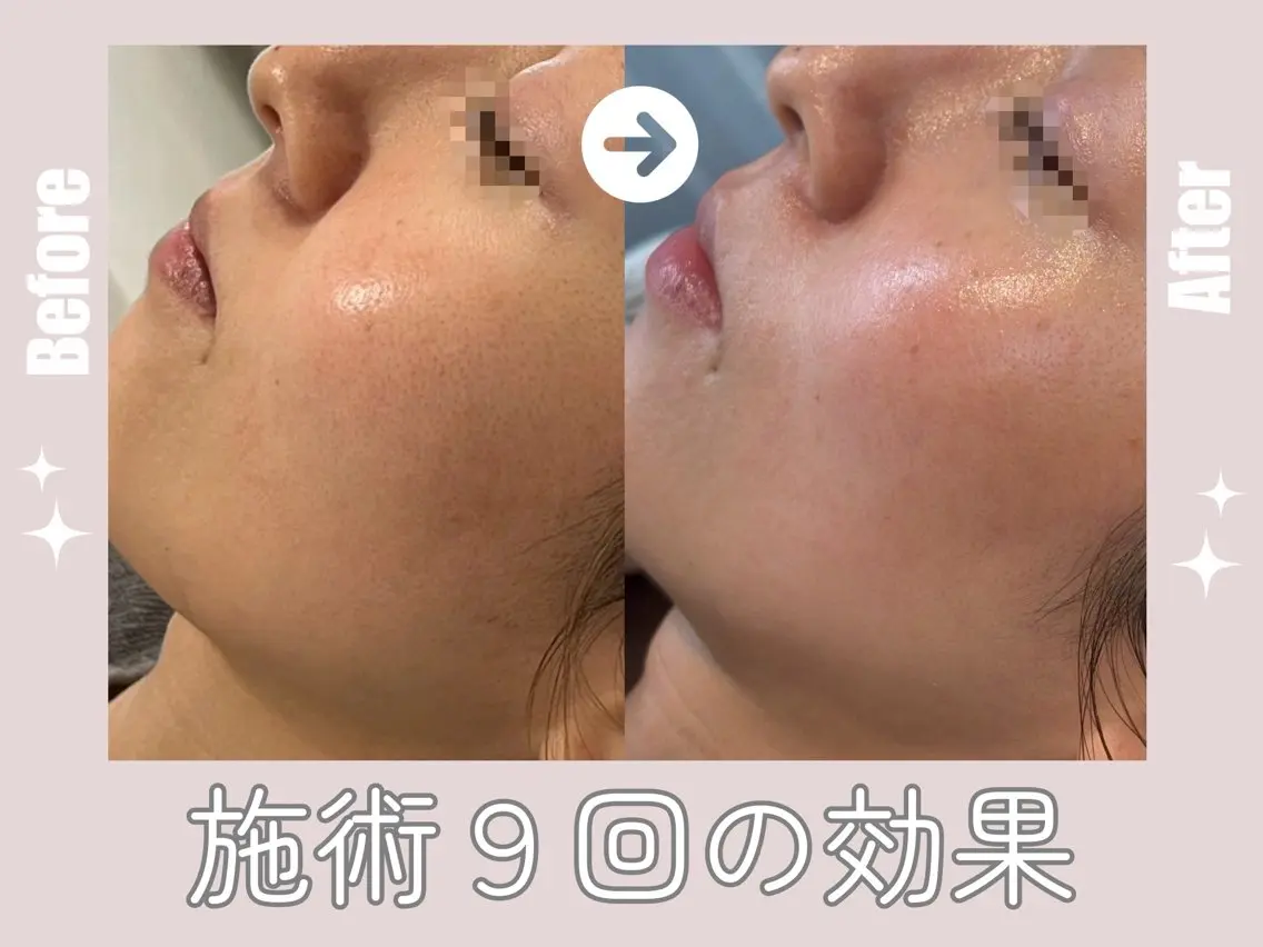 毛穴・ニキビケア ¦肌質改善¦EMIのエステ・リラクイメージ
