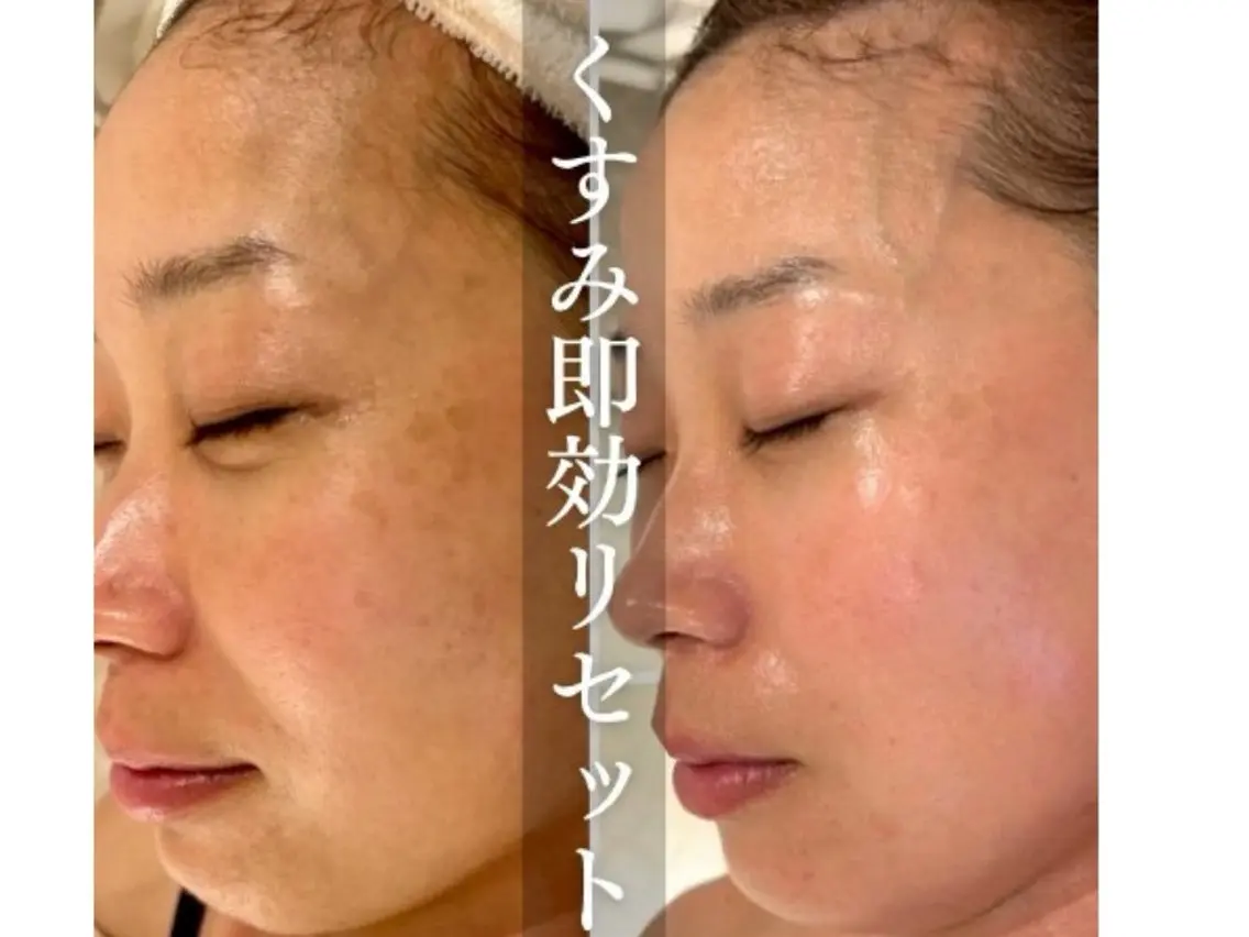 「ざらつき・シミ・くすみ・ニキビ跡」でお悩みの方はコレ！」ダイヤモンドのような完璧肌へ【ダイヤモンドピーリング】の写真