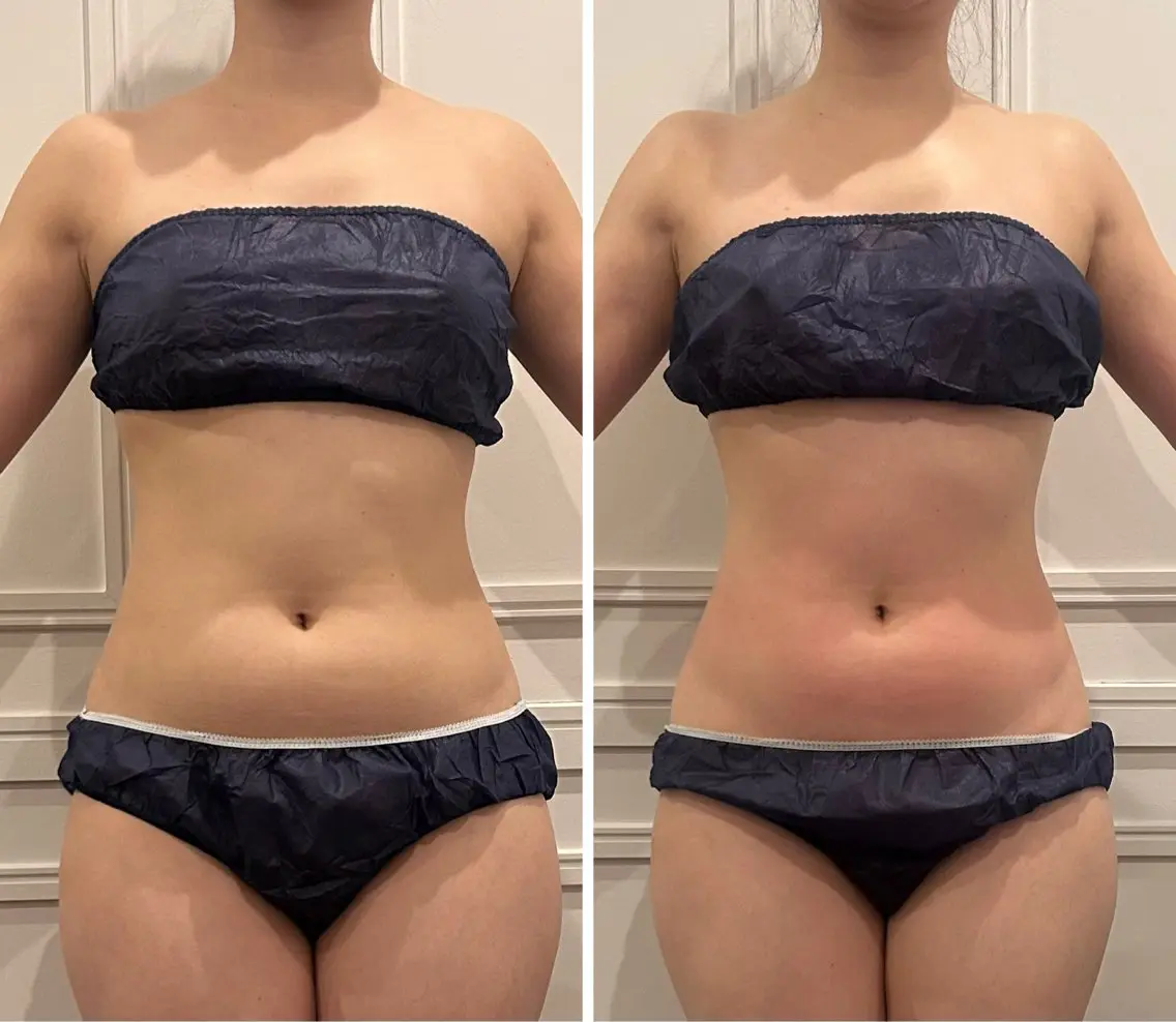 — Body Menu — 《くびれメイク》お腹周りの脂肪が気になる方にオススメ◎ ハイパーナイフEX✨の写真