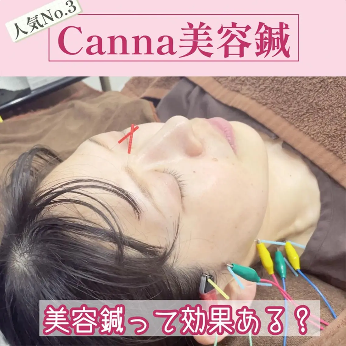 【美容鍼・小顔鍼】 鍼灸師 吉田洋美のエステ・リラクイメージ