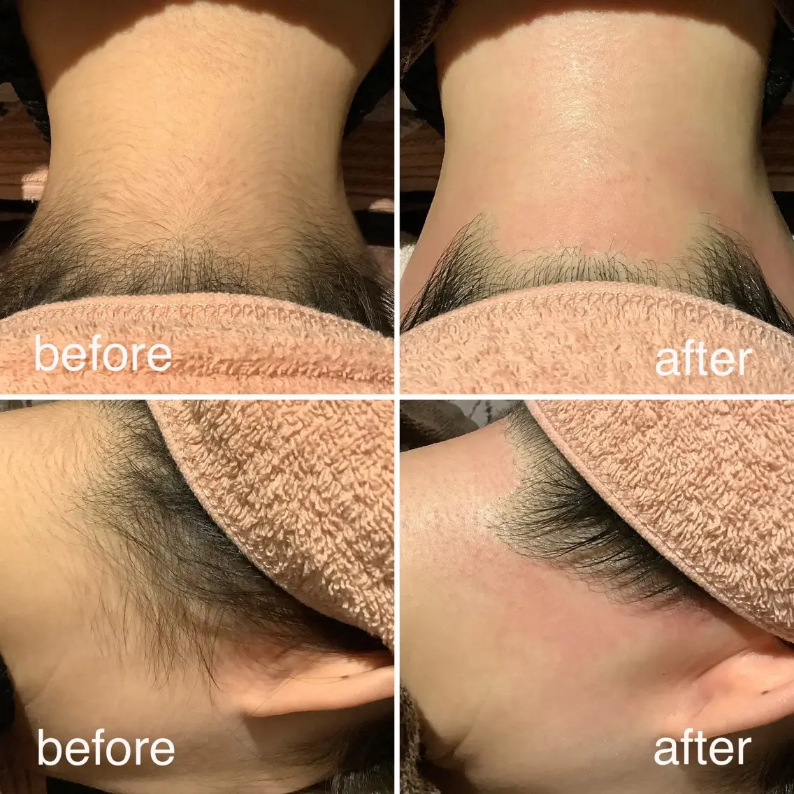 【WAX＋光脱毛】うなじ脱毛🧡スッキリうしろ姿も美人に✨の写真