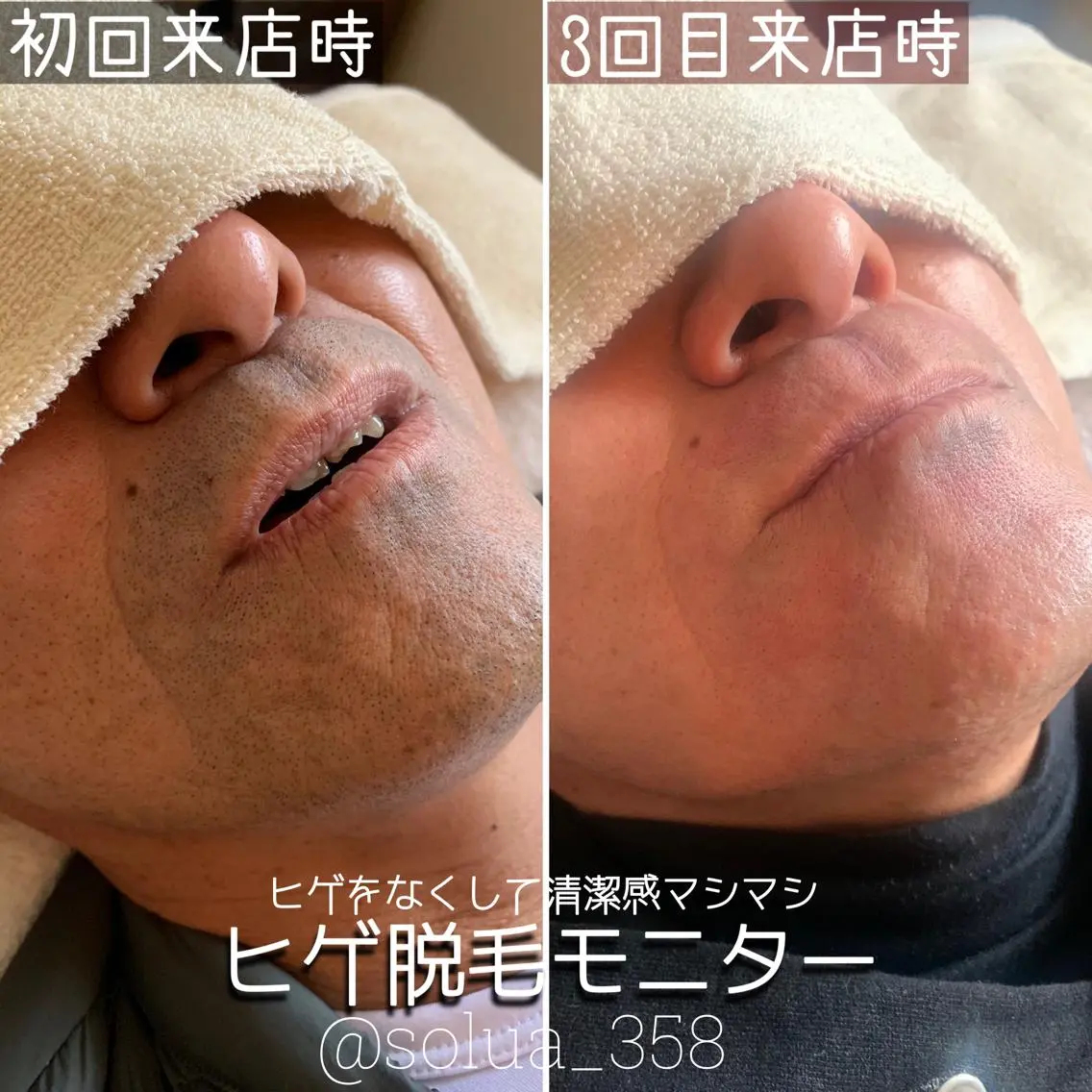 メンズ 脱毛 solua Ayamiのマツエク・マツパデザイン