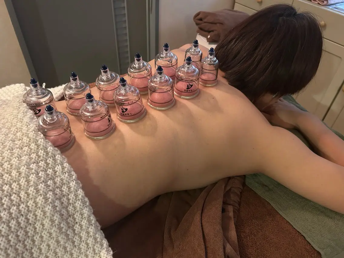 吸い玉カッピングで血の巡り改善！の写真
