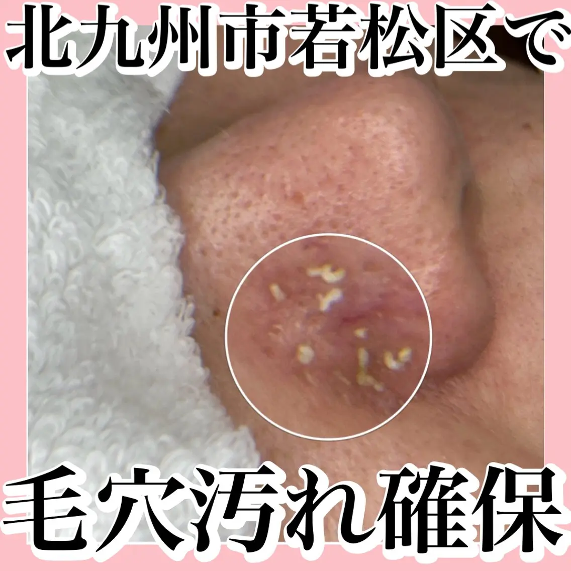 毛穴美人コースの写真