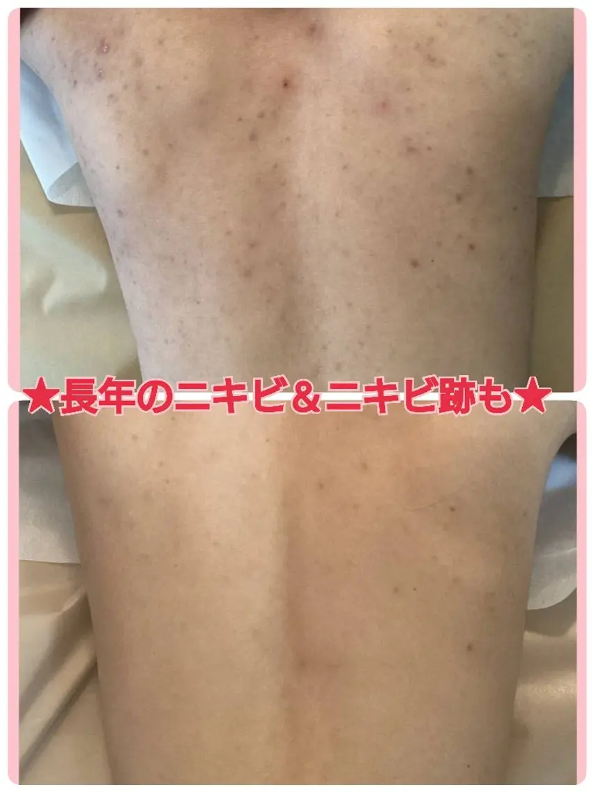 🌿Bodyハーブピーリング＆美容洗浄🌿剥離あり🌿背中、腰、二の腕、お尻、デコルテ等🩵ニキビ、ニキビ跡、色素沈着の写真