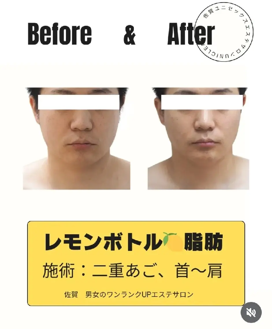 佐賀市│小顔 レ モンボト ル★顔の脂肪が多い方用の写真