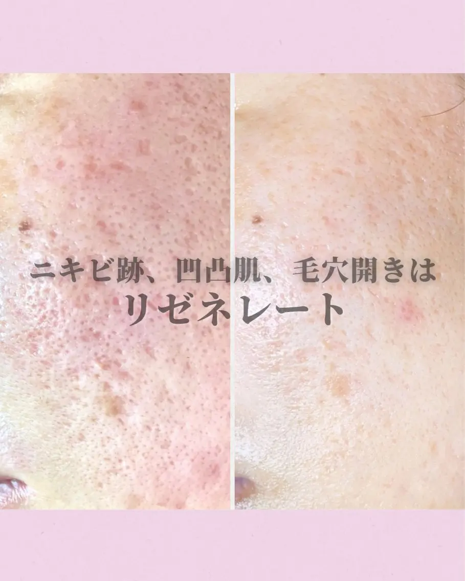美容版ダーマペン"リゼネレート"の写真