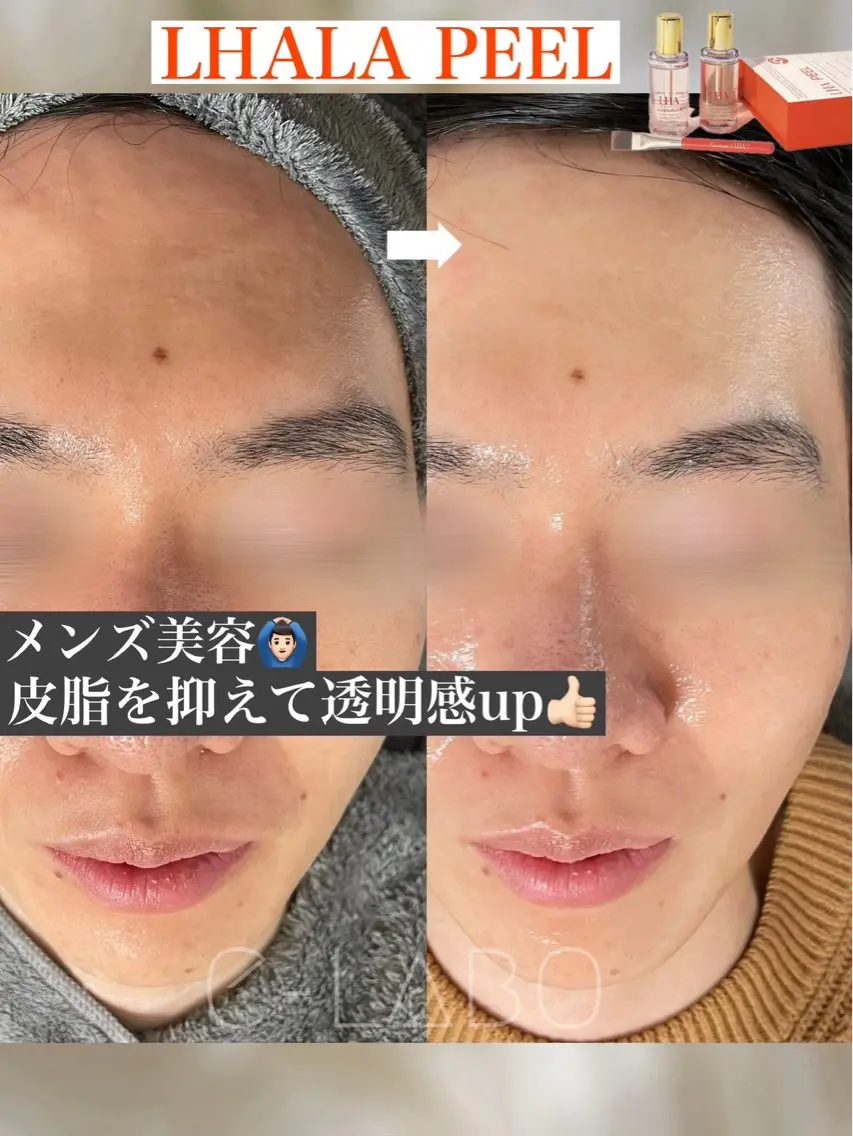 ⚠️現金のみ⚠️ 【モニター様募集/口コミ必須】韓国肌管理×ララピールの写真