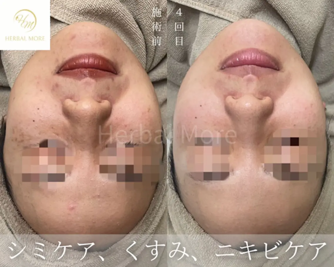 《レベル強め★★★》顔用/剥けるハーブピーリングの写真