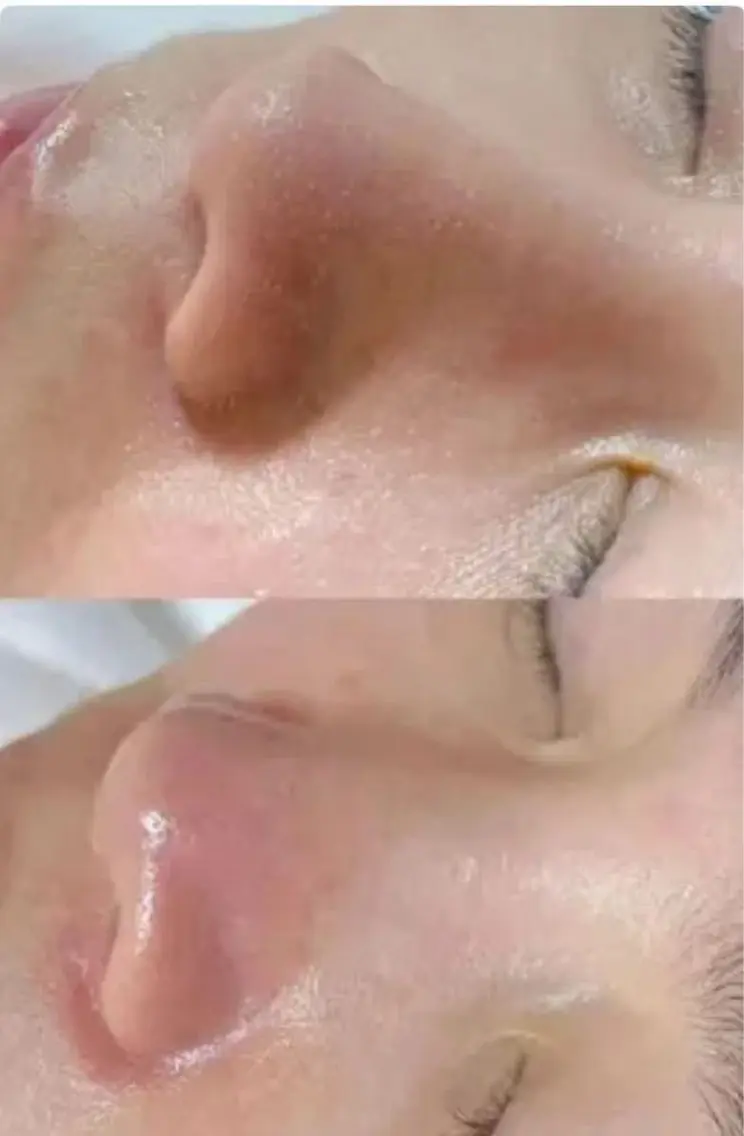韓国毛穴洗浄50分<デコルテ付き>の写真