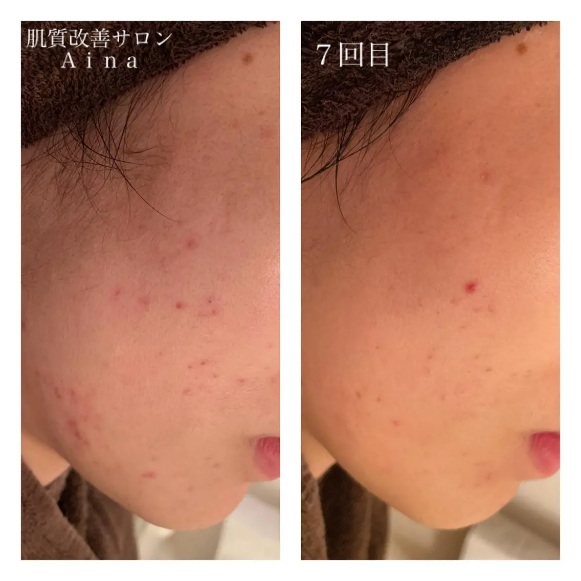 セミロング カラー パーマ ヘアアレンジ メンズ キッズ マツエク・マツパ エステ リラク ニキビ跡専門サロン Ainaのエステ・リラクイメージ