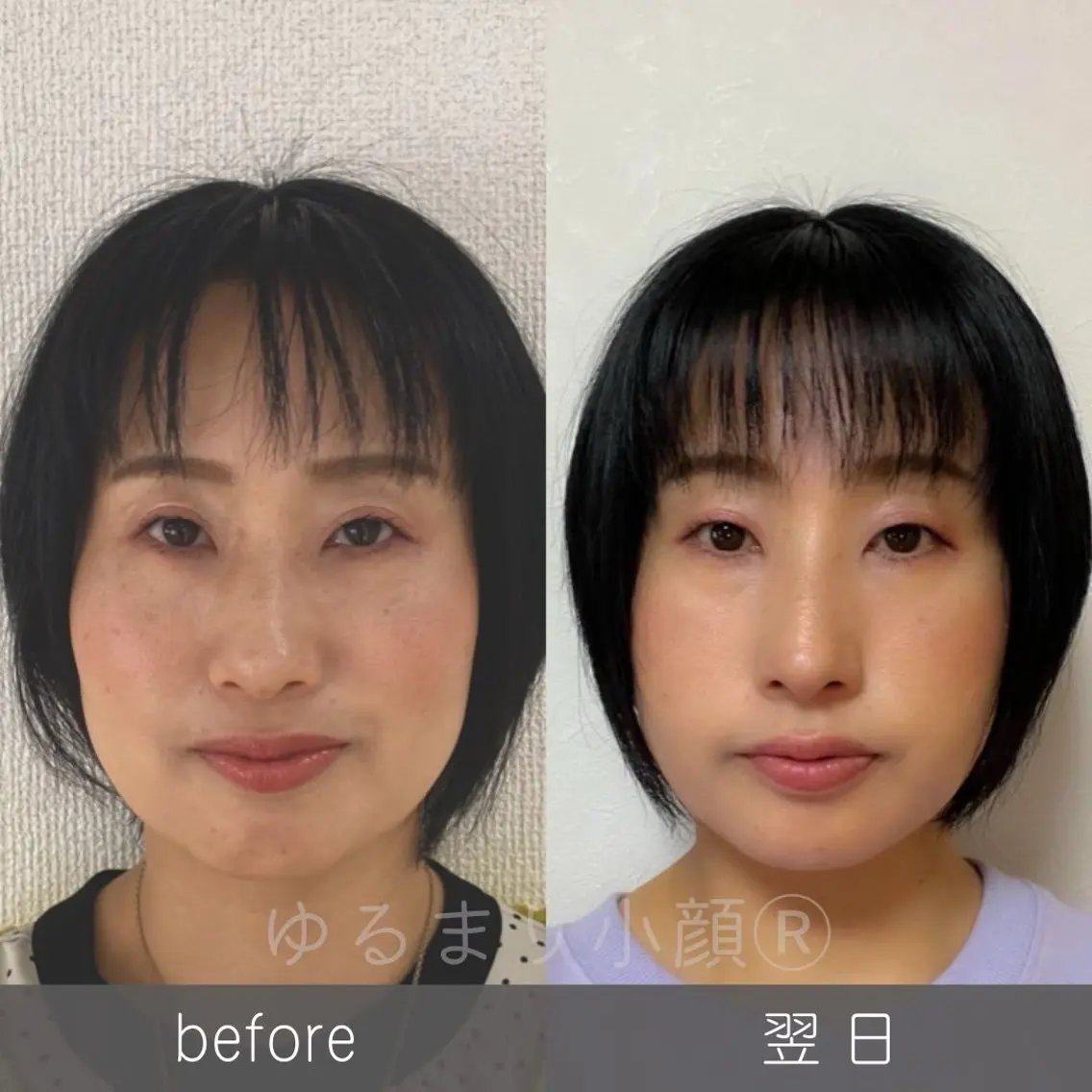 エステの枠を超えた変化♡優しいタッチの小顔矯正【頭蓋骨調整+タルミ解消フェイシャル+頭蓋骨ケア】65分 半額の6500円の写真