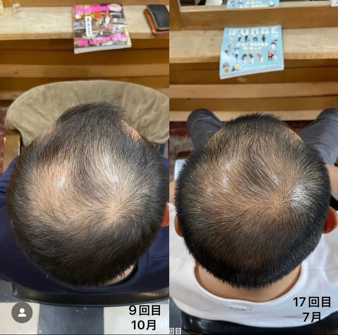 メンズ 分け目・つむじ 自然増毛専門のヘアスタイル